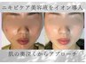 ニキビで悩んでる人専用メニュー