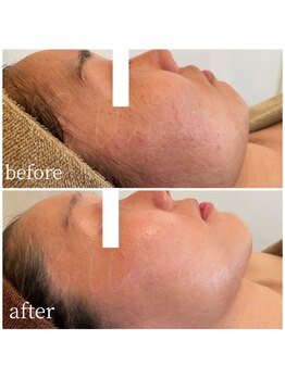 ベレミアム(Bellemium)/ニキビケア、ごわつき改善