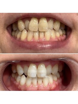 エピシアドットエヌ(epicia.N)/持続力のある白さ