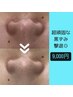 【毛穴洗浄+ヒト幹部分導入】ハイドラ毛穴洗浄×ヒト幹細胞100％導入