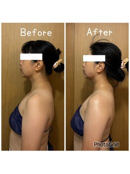 ハニー(Honey82)/全身リンパ+コルギ 比較写真