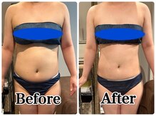 ルアナ(Luana)/《脂肪冷却》お腹おすすめ！