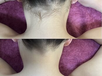 GRACETHOUSAND(グレイスサウザンド)/うなじ脱毛/セルフ脱毛