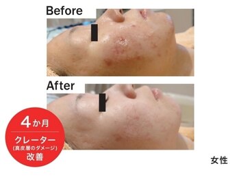 トリアングル(TLIENGLE)/最新ポレーションビフォアフ