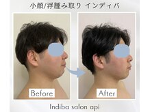 アピ(api)/症例写真【むくみインディバ】