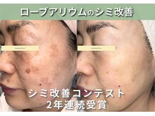 【シミ・肌質改善】L’aube allium ローブアリウム 芦屋　