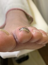 ランカ(RUNKA)/人差し指の巻いた爪