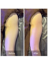 アムスパ(Aum Spa)/太もも脂溶解液導入