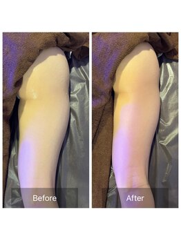 アムスパ(Aum Spa)/太もも脂溶解液導入