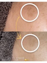 ラエッセ 恵比寿(LAESSE)/毛穴・美白専門店 LAESSE 恵比寿