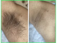 クリア 尾張旭店(Clear)/【Clear脱毛ビフォーアフター】