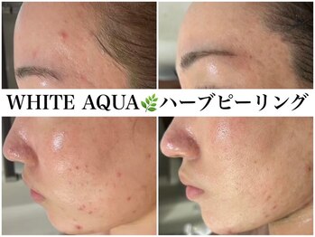 アワピール 天王寺店(AWA PEELL)/ハーブピーリング/ニキビケア