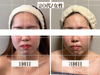 コガオラボ 甲府店(KOGAO LABO)/お客様☆Before&After☆