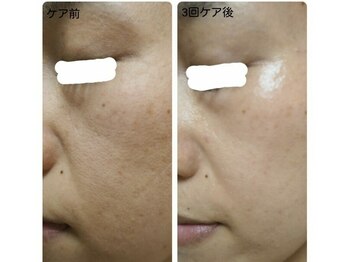 エステ デ アイリス(Esthe de Iris)/スポンジアトリートメント