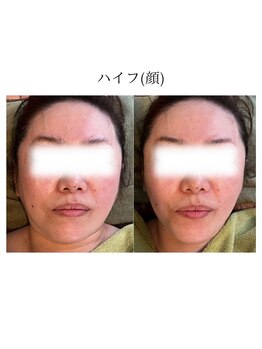 ディアレスト(Dearest)/ハイフ(顔)3層アプローチ