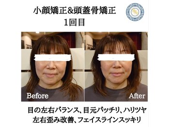 RKY/左右の歪み改善