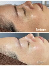 レシェルサロン(Lechelle Salon)/ハーブピーリング＋オプション