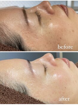 レシェルサロン(Lechelle Salon)/ハーブピーリング+オプション