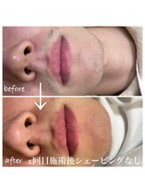 タートル(TURTLE)/ひげ脱毛の変化★１回目施術後