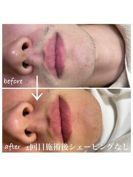 タートル(TURTLE)/ひげ脱毛の変化★１回目施術後