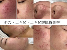 アロマ(AROMA)の雰囲気（肌荒れ徹底改善！ニキビケア専門◎越谷/せんげん台/大宮/春日部）