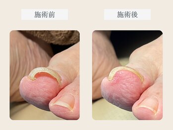 ルポ 伊勢/巻き爪ケア