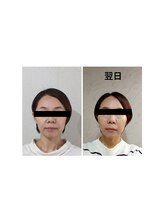 ミヤビ(miyabi)/小顔矯正