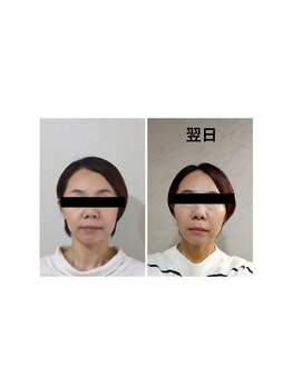 ミヤビ(miyabi)/小顔矯正