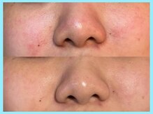 ヴィオール 名古屋栄店(VIOR)/TETEピール★ 赤み・肌質改善