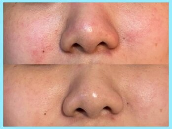 ヴィオール 名古屋栄店(VIOR)/TETEピール★ 赤み・肌質改善