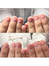 セラキュアネイル(Theracure nail)/地爪育成により美しく健康な爪に