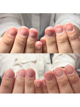 セラキュアネイル(Theracure nail)/地爪育成により美しく健康な爪に