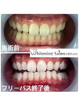 ホワイトニングサロン 京都烏丸店/ホワイトニング施術例