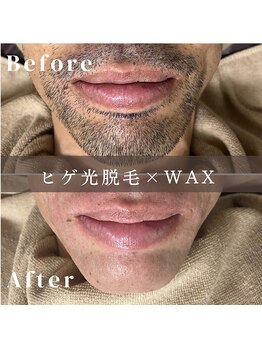 エピナ 秋田店(Epina)/ヒゲMIX脱毛★