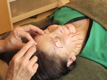 モカ(MOKA)/美容鍼