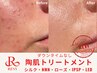 リピーター様《本気の肌質改善》ニキビ撤退/贅沢フルオプション6種【完全版】