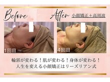 リーズリアン(Rises Lien)/【BeforeAfter】20代 リフトUP!