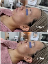 リエル(Liel)/ダクトピール1回目 before/after