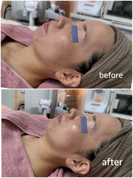 リエル(Liel)/ダクトピール1回目 before/after