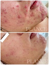プランス 恵比寿店(PLANCE)/皮膚科でも改善が難しい肌荒れ◎