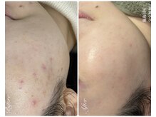 プレローマ(Pleroma)の雰囲気(繰り返す肌荒れに◎土台から整えるお手伝いをさせていただきます)