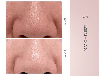リアン(Lien)の写真/年代別の毛穴悩みに、ピーリング・エクストラクション・レチノール・ソフトダーマで最短ルートの滑らか肌へ