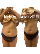 リリーボーテ 下北沢/インディバ施術（お腹）