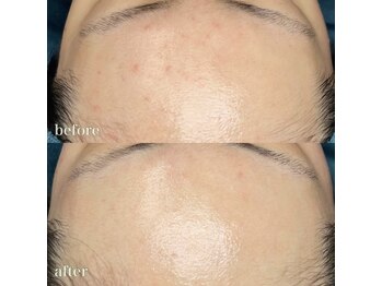 ちらちゅら/クリスティーナ【施術経過】