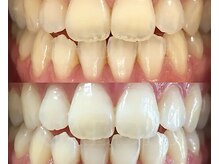 ライトケアサロン 表参道店(Light Care Salon)/セルフホワイトニング