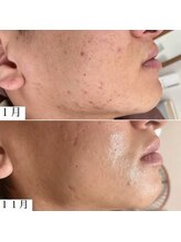 ラエッセ 恵比寿(LAESSE)/毛穴・美白専門店 LAESSE 恵比寿