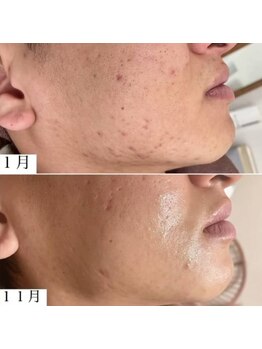 ラエッセ 恵比寿(LAESSE)/毛穴・美白専門店 LAESSE 恵比寿