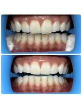 アーヒル(A”-HILU)/ホワイトニング