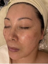 ラシェプリズ(LACHER PRISE)/施術経過（40代）