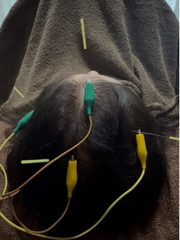 カナデ(kanade)の写真/鍼灸/頭皮鍼＊辛いコリや疲労、女性特有のお悩み改善にも効果◎-kanade- 奏でお悩みスッキリ解消が叶う！